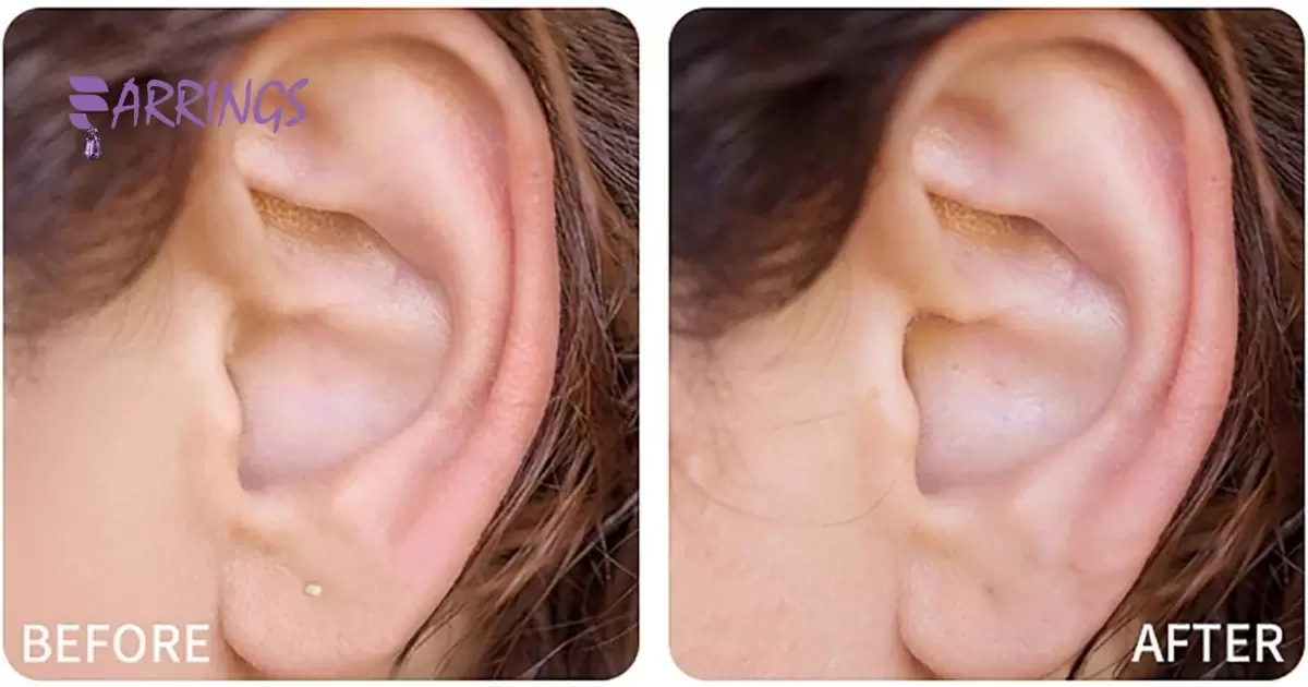 How long it takes for a piercing to close and what to do if it happens