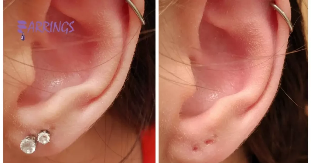 How To Close Ear Piercing Hole Permanently?