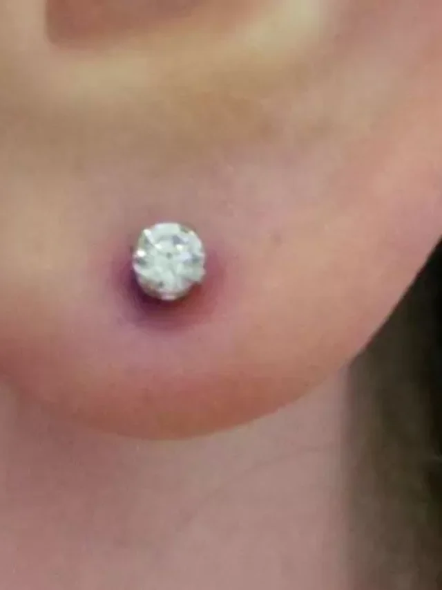 Do Plastic Earrings Cause Infection?